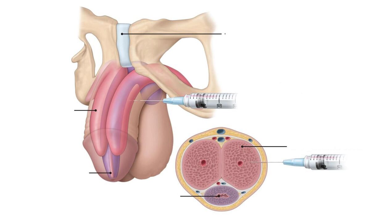 Injections to increase potency